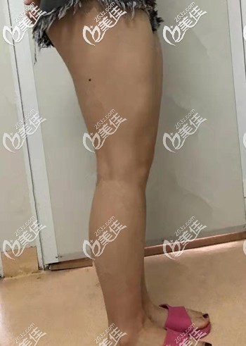 大腿吸脂前脂肪堆积 大腿吸脂前脂肪堆积