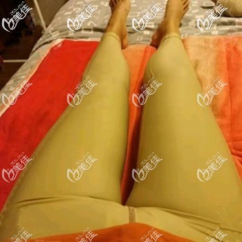 大腿吸脂后会有轻微的疼痛感 大腿吸脂后会有轻微的疼痛感