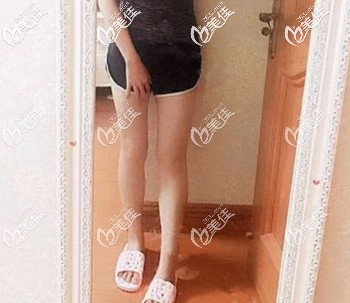 做大腿吸脂后因为残留的肿胀液疼痛感很轻 术后一周就走路上班了