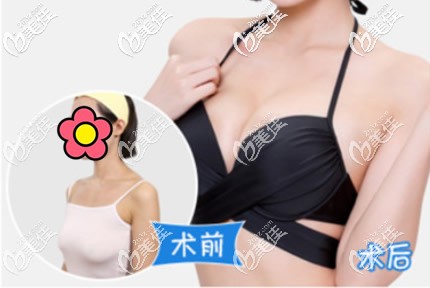 乳房下垂矫正效果对比