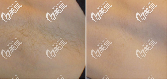 冰点脱毛案例图 冰点脱毛案例图