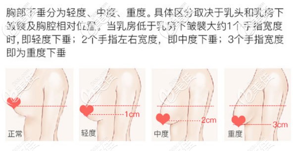 乳房下垂的程度