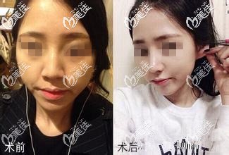 耳软骨隆鼻对比案例 耳软骨隆鼻对比案例