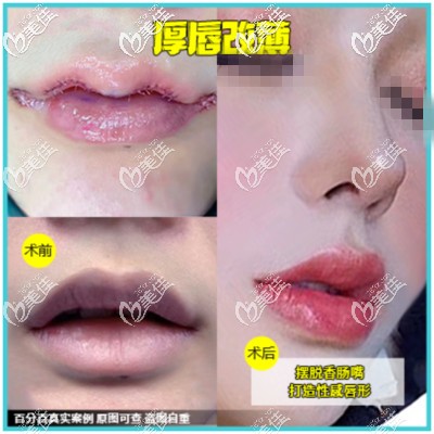 厚唇改薄术对比案例 厚唇改薄术对比案例