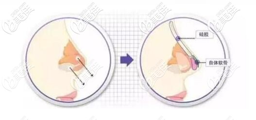 综合隆鼻手术原理 综合隆鼻手术原理