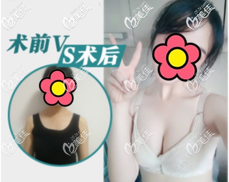 韩国蓓拉300cc毛面假体隆胸前后效果对比照片 韩国蓓拉300cc毛面假体隆胸前后效果对比照片