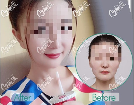下颌角整形前后对比照片 下颌角整形前后对比照片