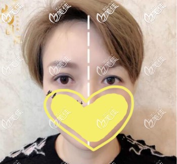 韩国me无痕双眼皮15天效果 韩国me无痕双眼皮15天效果