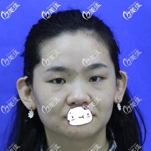 术前眼睛是内双肿泡眼 术前眼睛是内双肿泡眼