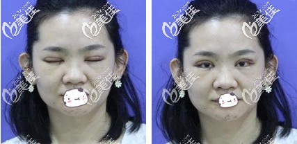 刚做完双眼皮手术眼睛肿胀厉害 刚做完双眼皮手术眼睛肿胀厉害