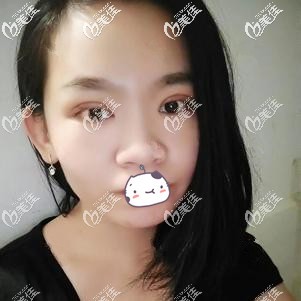 双眼皮手术一周眼睛微肿胀 双眼皮手术一周眼睛微肿胀
