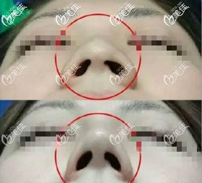 刚做完缩鼻翼三个月效果图 刚做完缩鼻翼三个月效果图