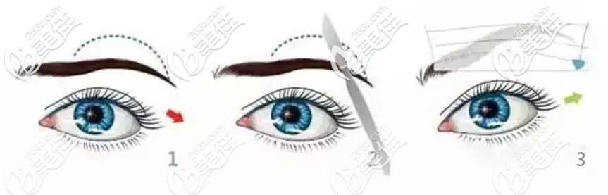 切眉术过程