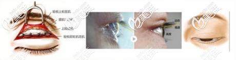 周洪超睫毛入路双眼皮手术原理示意图 周洪超睫毛入路双眼皮手术原理示意图