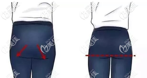 提臀线手术的位置 提臀线手术的位置