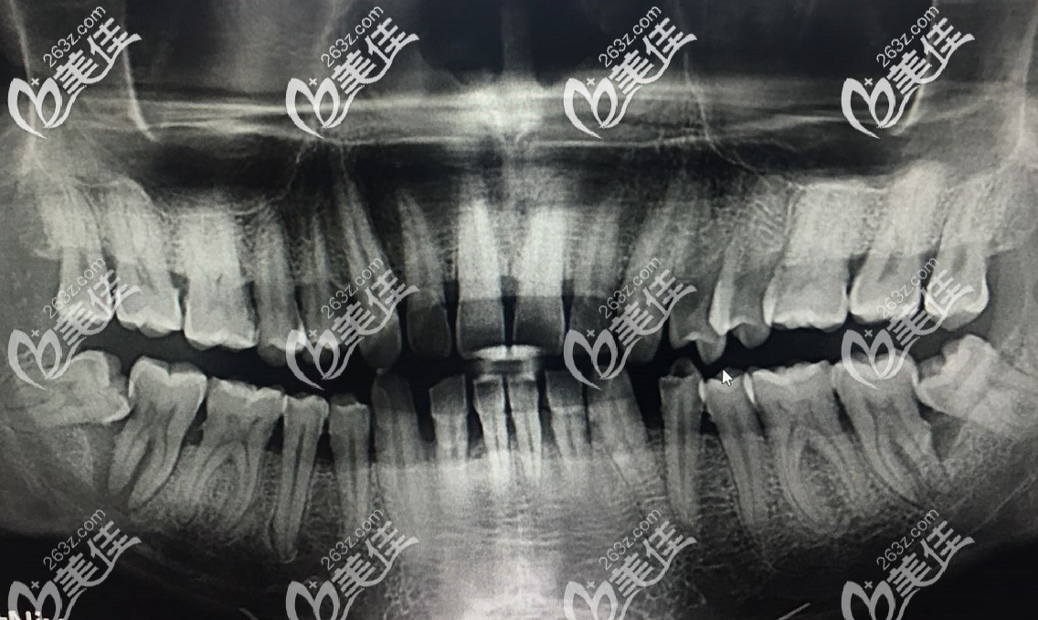 第二磨牙被智齿顶坏了是该做种植牙还是做根管治疗
