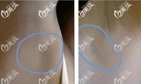 腋下切口疤痕恢复效果 腋下切口疤痕恢复效果