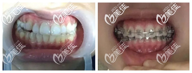 3M自锁托槽前后对比图 3M自锁托槽前后对比图