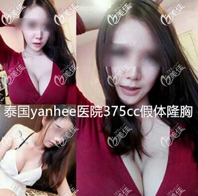 泰国yanhee然禧隆胸案例