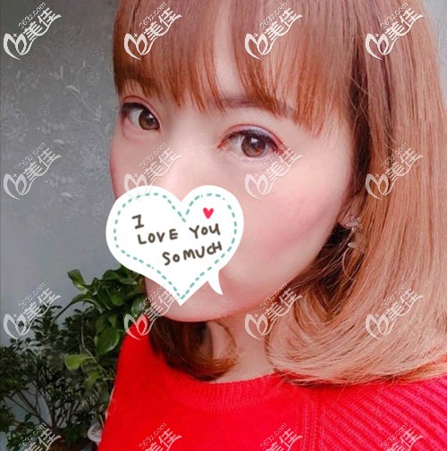 双眼皮开眼角2个月效果就很自然了 双眼皮开眼角2个月效果就很自然了