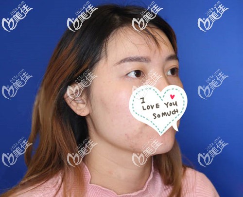 眼皮松弛后一个眼睛单一个眼睛双 眼皮松弛后一个眼睛单一个眼睛双