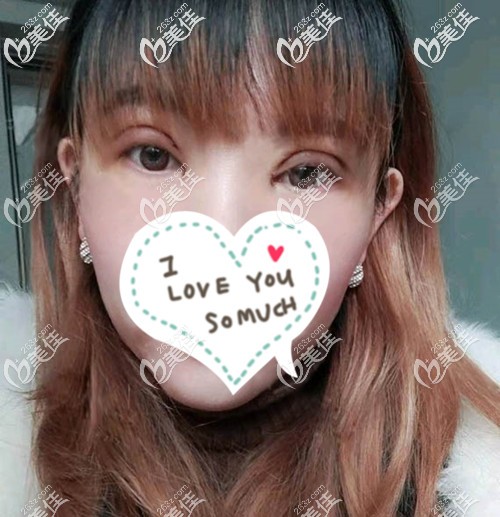 刚做完双眼皮开眼角的时候眼睛并不是很肿 刚做完双眼皮开眼角的时候眼睛并不是很肿