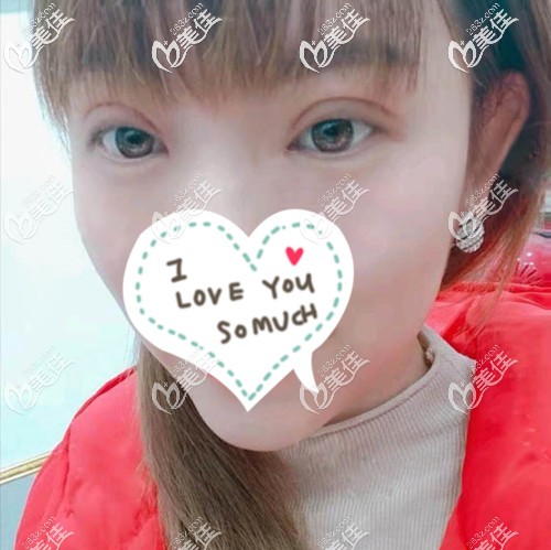 术后3天双眼皮肿的特别厉害 术后3天双眼皮肿的特别厉害