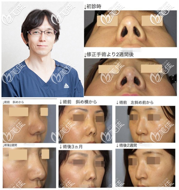 横山才也医生隆鼻修复案例
