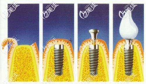 传统种植牙过程 传统种植牙过程