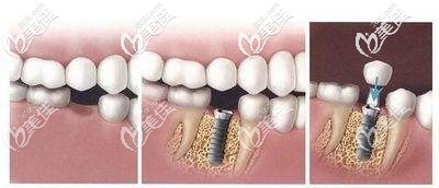 即刻种植牙过程 即刻种植牙过程