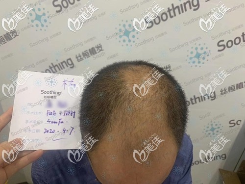 4000个毛囊能植发多大面积 4000个毛囊能植发多大面积