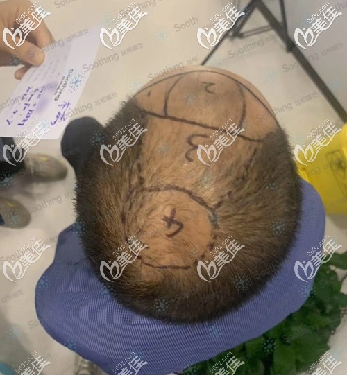 植发前设计了种植方案 植发前设计了种植方案