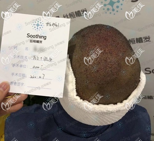 5级脱发植发4000单位即刻<span style= 5级脱发植发4000单位即刻<span style=