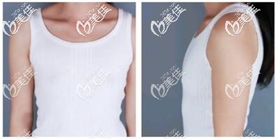 假体隆胸手术前 假体隆胸手术前