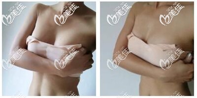隆胸手术拆线后7天 隆胸手术拆线后7天