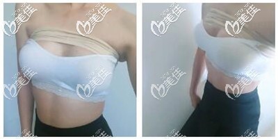 假体隆胸手术术后恢复1个月 假体隆胸手术术后恢复1个月