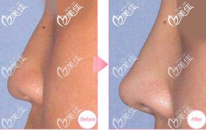 耳软骨隆鼻后的效果对比 耳软骨隆鼻后的效果对比