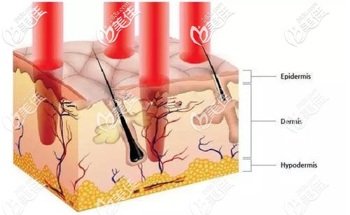 周海燕在激光美肤方面经验丰富