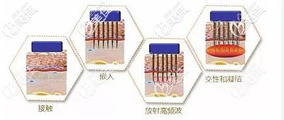 黄金微针去痘坑的优势 黄金微针去痘坑的优势