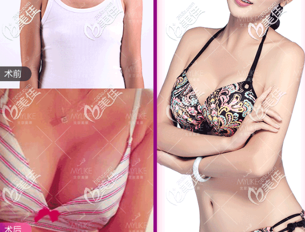 北京美莱董岩岩傲诺拉闪耀假体隆胸案例 北京美莱董岩岩傲诺拉闪耀假体隆胸案例