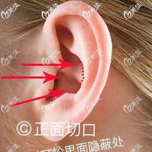 耳软骨隆鼻切口从前面取还是后面 担心耳朵疤痕增生 硅胶隆鼻 美佳网整形问答 耳软骨隆鼻切口从前面取还是后面 担心耳朵疤痕增生 硅胶隆鼻 美佳网整形问答