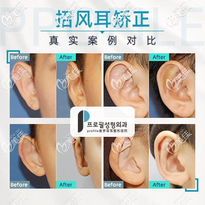 招风耳前后对比案例