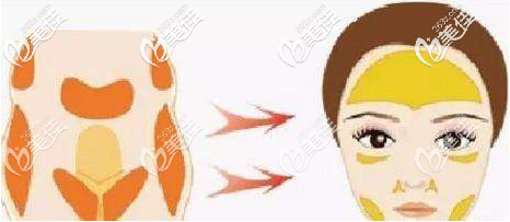 自体脂肪面部填充 自体脂肪面部填充