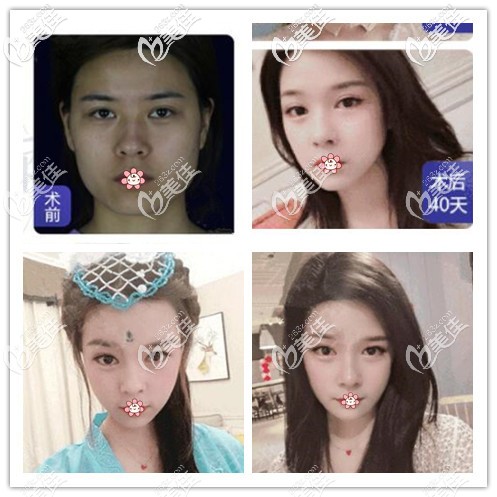 四川友谊医院谁磨骨好