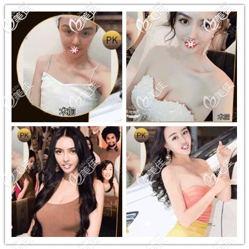 成都美锭美250cc假体隆胸案例 成都美锭美250cc假体隆胸案例