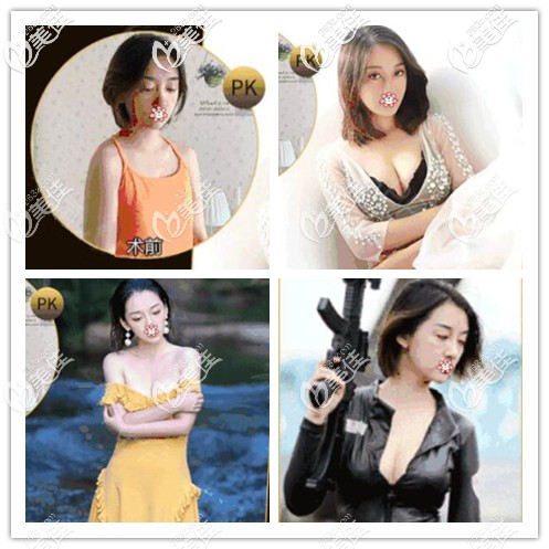 何一波270cc假体隆胸案例效果 何一波270cc假体隆胸案例效果