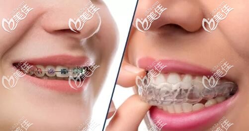 牙齿矫治器