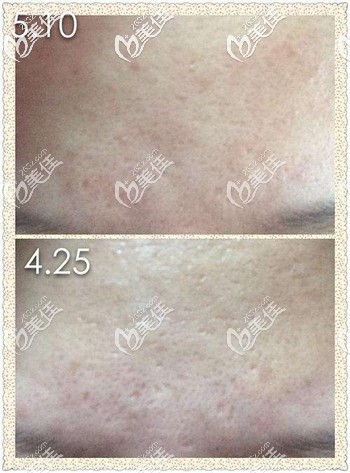 黄金微针去痘坑痘印后的效果 黄金微针去痘坑痘印后的效果