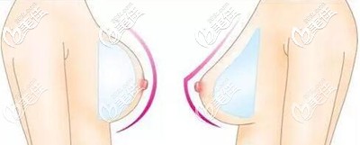 水滴形假体和圆形的区别 水滴形假体和圆形的区别