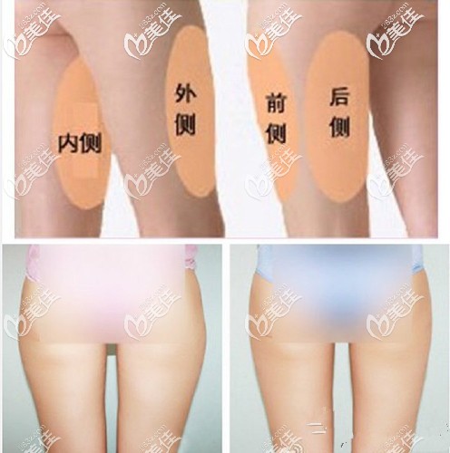 大腿吸脂改变臀型的方法 大腿吸脂改变臀型的方法